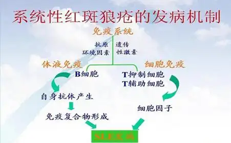 系统性红斑狼疮认识存在很多误区
