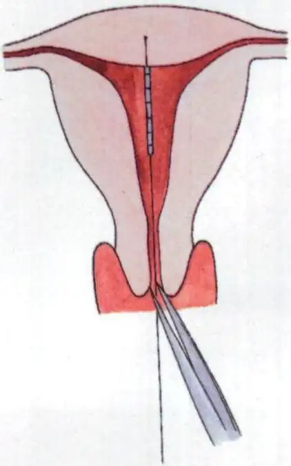 取环自己一个人就可以去医院吗