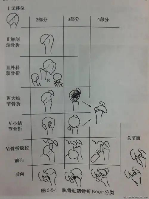 肱骨近端骨折分型