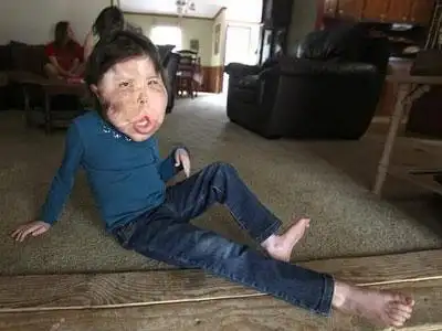 恐怖可怜!女孩患怪病天生大脸