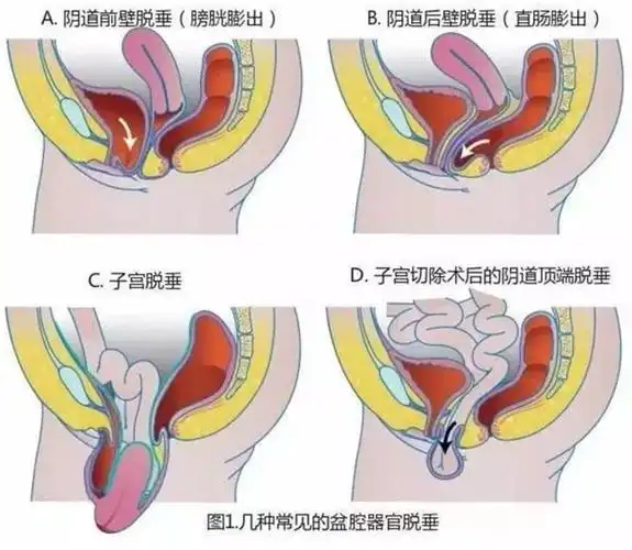 子宫脱垂严重的还要戴 子宫托,很折磨人.
