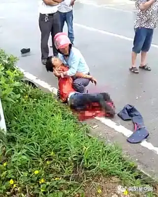 恶性潮汕某地发生车祸女子腿部骨肉分离