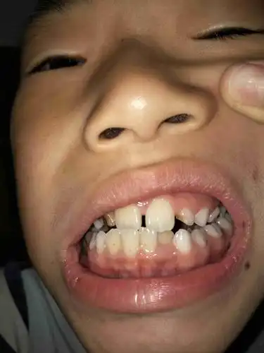 请专业人士帮我看看大门牙两边牙齿是乳牙还是换过的新牙啊?