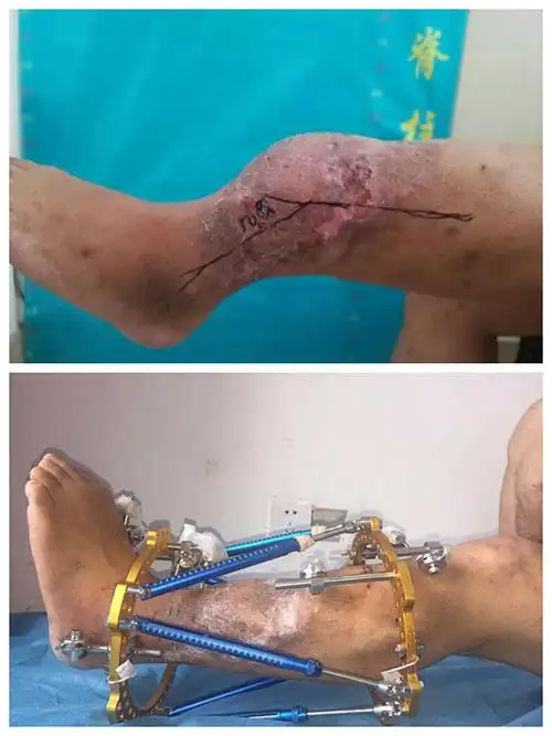 江西省人民医院开展首例"泰勒六轴外架矫正小腿足踝畸形"技术
