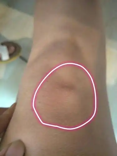 平时我跑步,骑自行车,运动量有点大,最近发现膝盖这个地方骨头突出,求