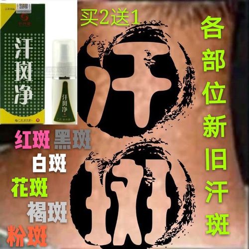 汗斑净去除褐色汗斑克星白斑汗斑露前胸部背部花斑藓汗斑专用药