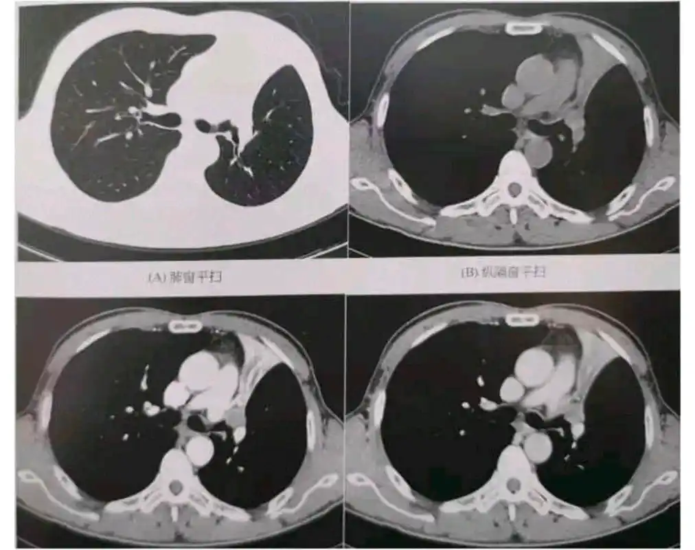 简述中央型肺癌特点及影像表现