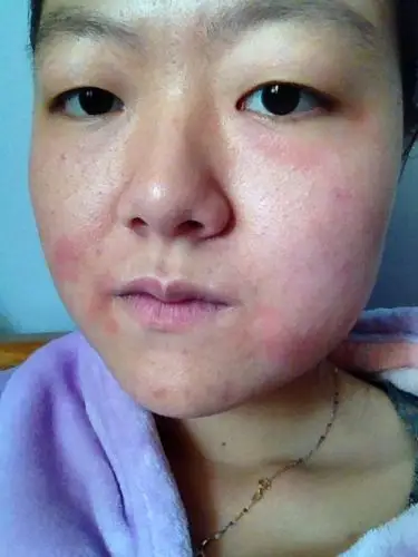 脸上起了一片片的红斑,又疼又痒,一片片的,像是癣一样,一个星期了