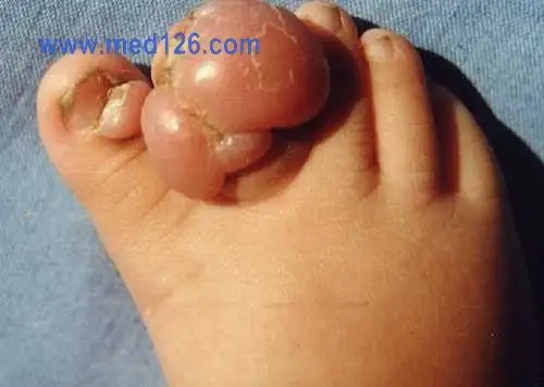 幼儿指纤维瘤病(infantile digital fibromatosis)