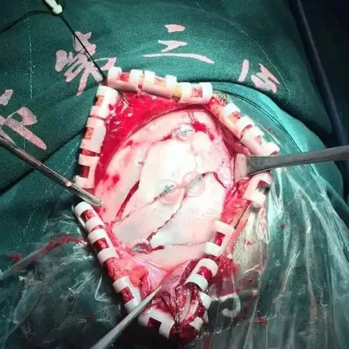 脑组织从伤口溢出,由宋增亮主任主刀行开放性颅脑损伤,开颅清创术和颅