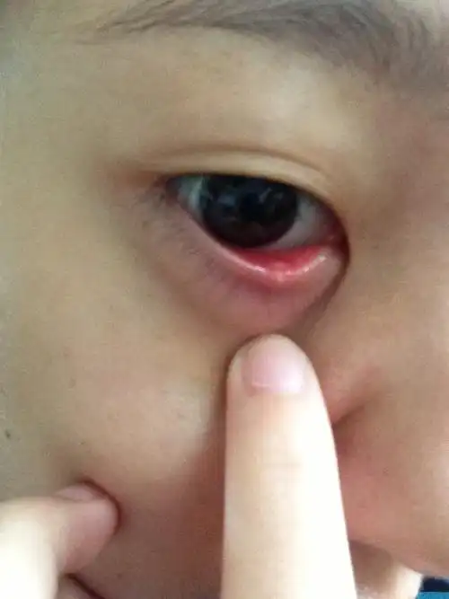 眼睛上眼皮长针眼图片-图片大观-奇异网