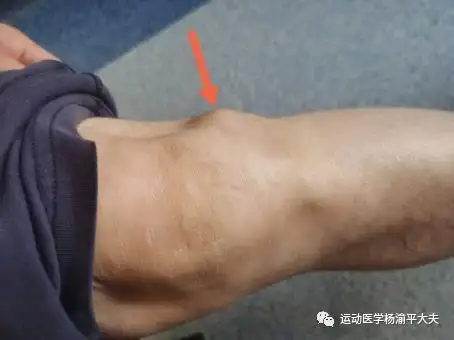 爱复发的膝关节小毛病半月板囊肿的处理