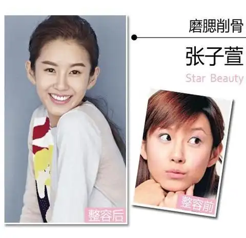 郑爽张子萱"百变整容脸" 哪些部位出卖了你