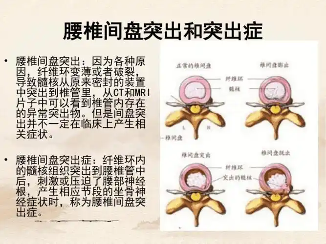 腰椎间盘突出症的康复治疗pptppt