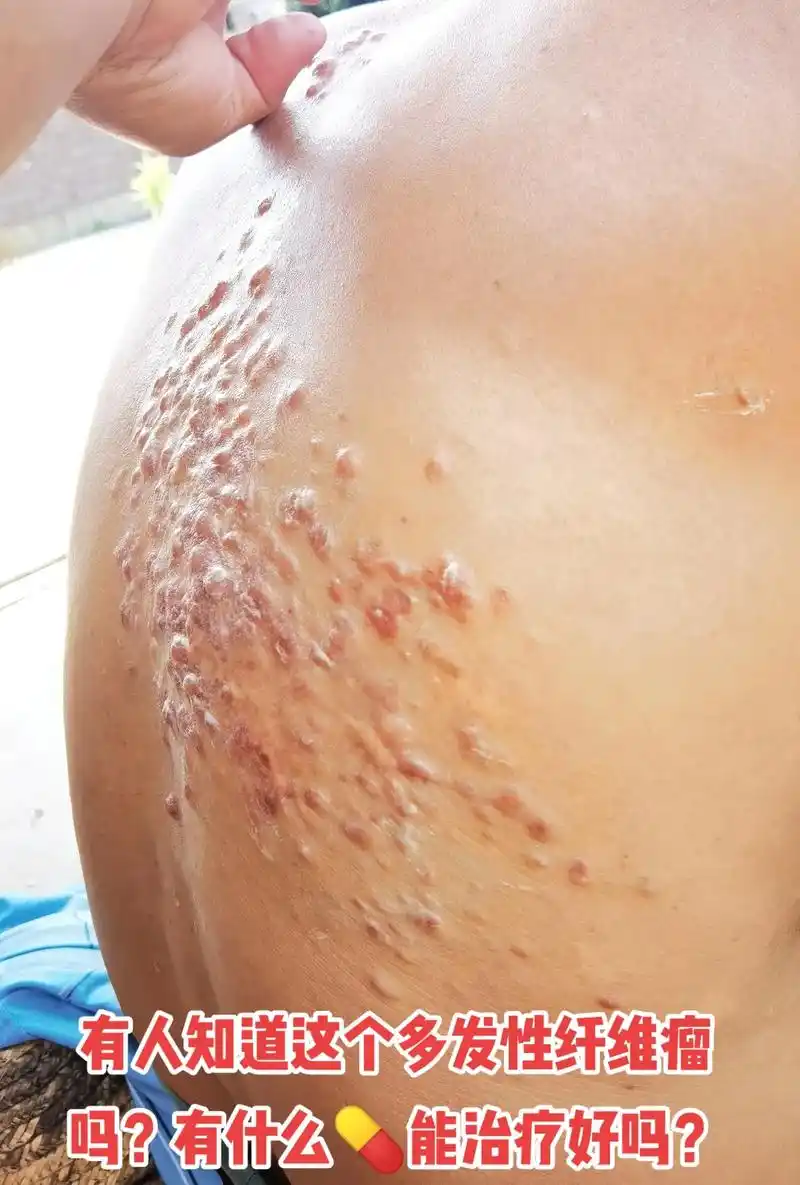 万能的抖音有人知道治好多发性纤维瘤的17 - 抖音