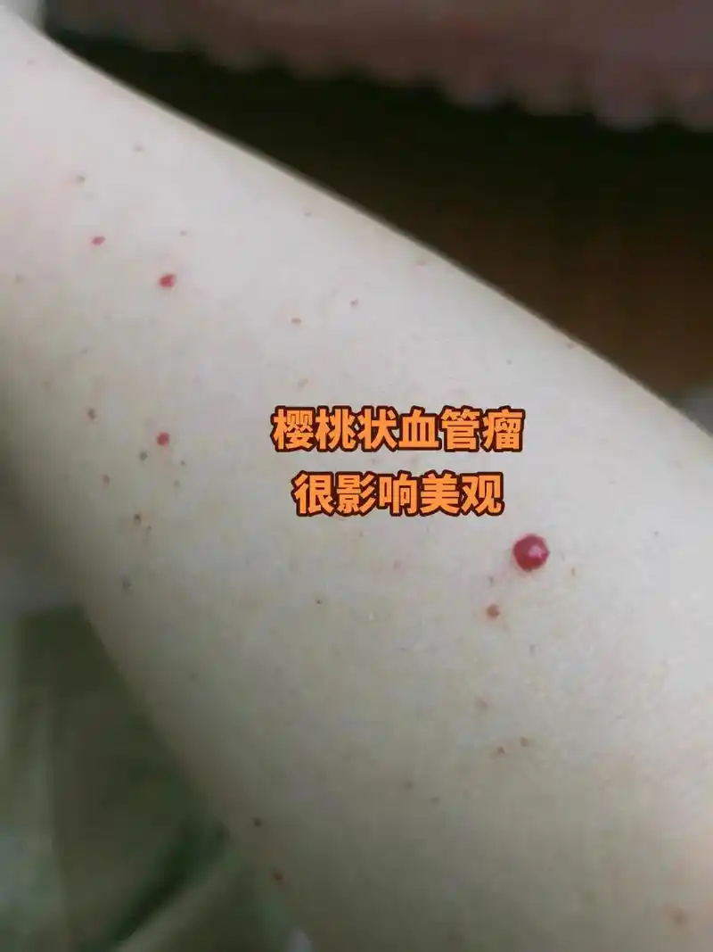 樱桃状血管瘤不要去揉搓刺激它早治疗早好