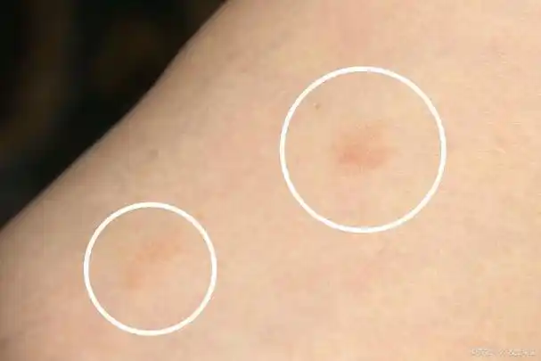 汗斑(花斑癣)都有哪些症状?哪些情况易导致这种皮肤病?