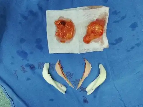 下颌角截骨手术(改脸型)的黑科技