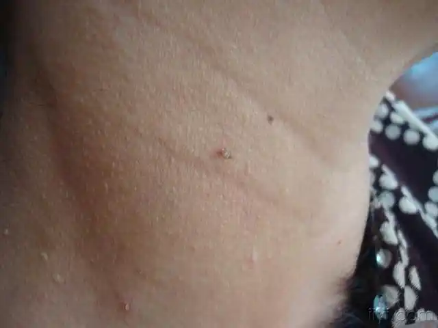 脖子,腋下的"小肉粒"是什么?会影响健康吗?建议引起重视