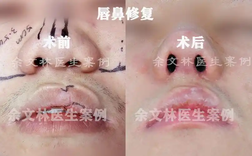 兔唇二次修复后效果图