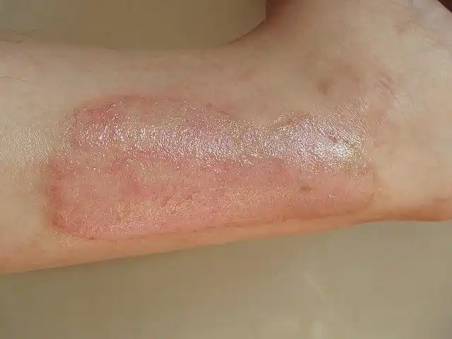 烧伤性疤痕的预防工作