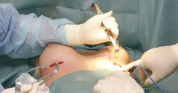 实拍国外美女隆胸手术全过程