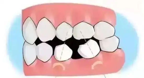 门牙为什么会歪斜