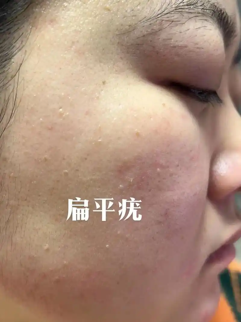 你是哪种疣?怎么办71 1.增强免yi力 (多吃水果蔬菜,保持 - 抖音