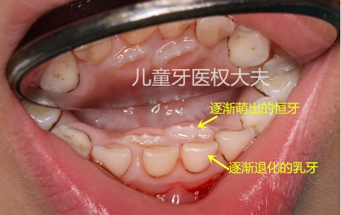 孩子出现两排下门牙是怎么回事? - 好大夫在线