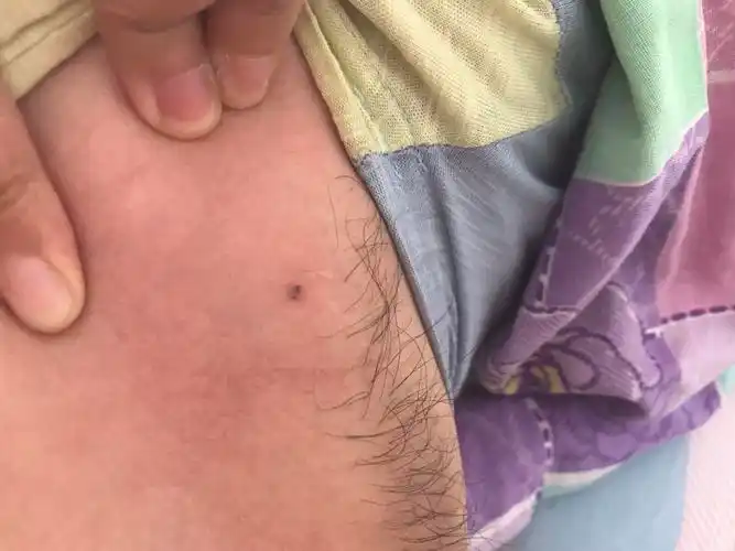 展开全部 好像是个痣吧   有照片看下吗  只能拍这个样子了