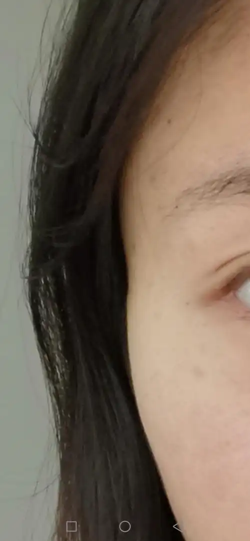 戴眼镜导致的太阳穴凹陷能恢复吗