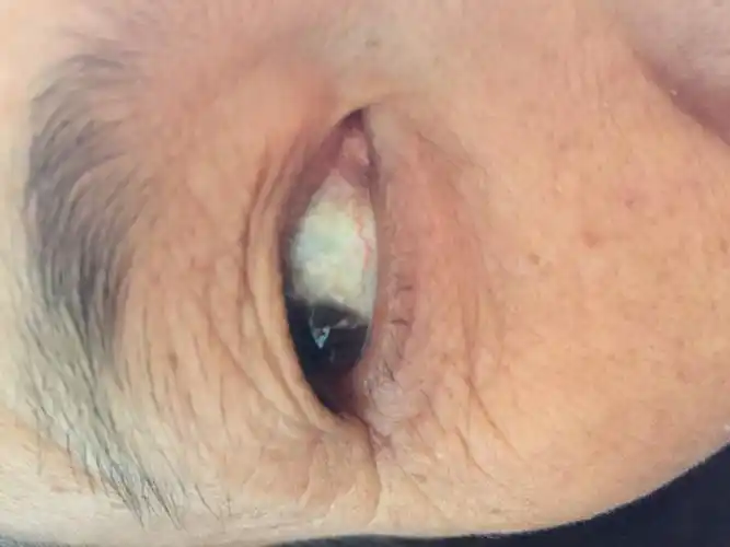 感觉是眼白黄斑而且黄斑突出请专家帮我看一看是不是需要治