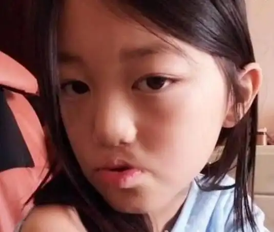 王菲小女儿兔唇为什么当时没查出来