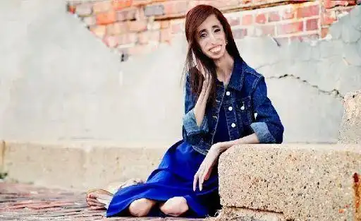 和马凡氏综合征类似,有一个叫做马凡样-早衰样-脂肪营养不良综合征