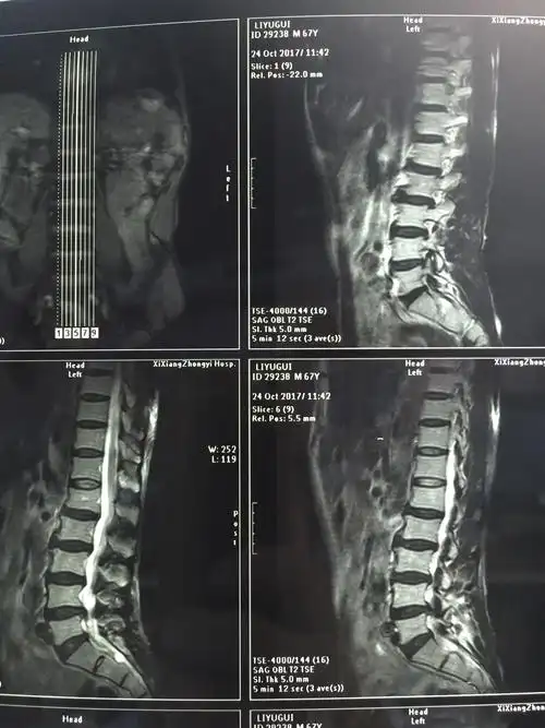 腰椎间盘突出合并腰椎管狭窄症