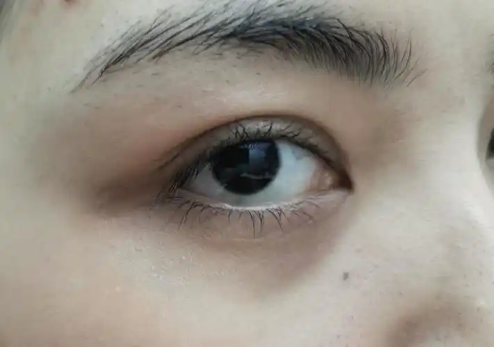 22岁这样的眼周细纹算严重吗求一款好用的去细纹眼霜