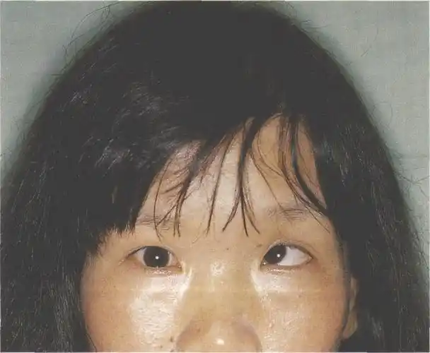 (图) 共同性内上斜视.左眼为交替眼