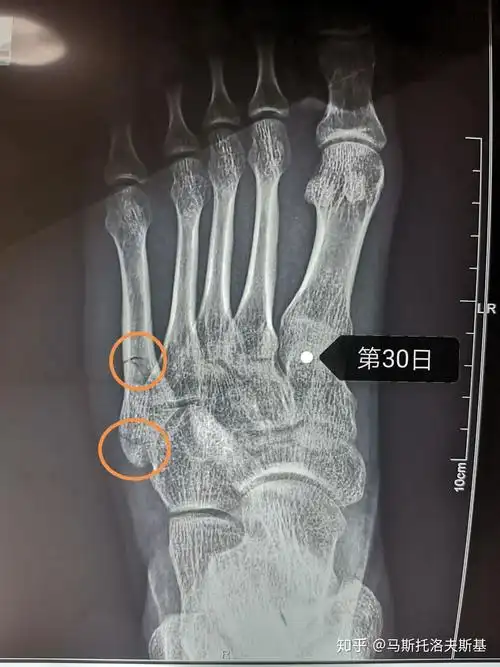 左脚第五跖骨骨折? - 知乎