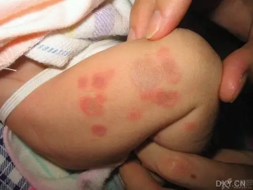 看图说话,新生儿皮疹