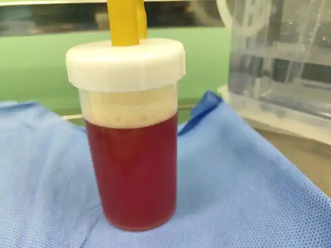 恶性胸水的克星——内科胸腔镜诊治胸腔积液新技术.