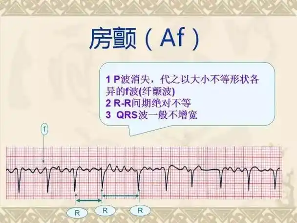 「收藏」执业医师考生必须掌握的常见异常心电图!