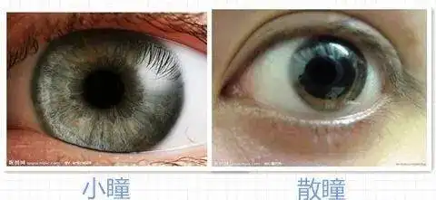 散瞳会伤害眼睛吗为什么眼镜店不用散瞳