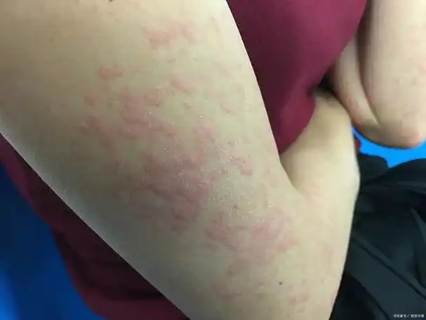 皮肤出现红点发痒怎么回事