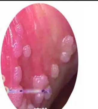 而尖锐湿疣感染男性后的症状表现男性尖锐湿疣,多出现在尿道口上,在