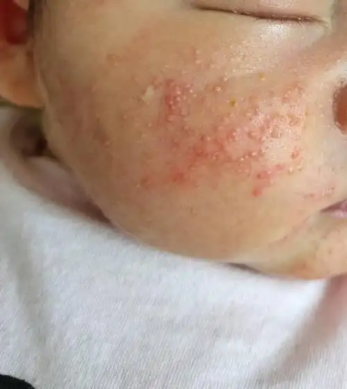 不久,在 白 白嫩 嫩的皮肤上就会 出现一些 惹人烦的湿疹,新生儿痤疮