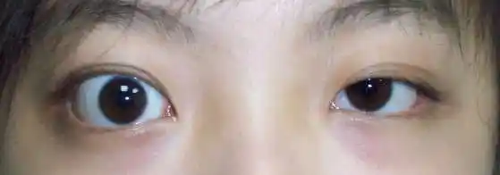 甲状腺相关性眼病(甲亢突眼)的诊治 - 好大夫在线