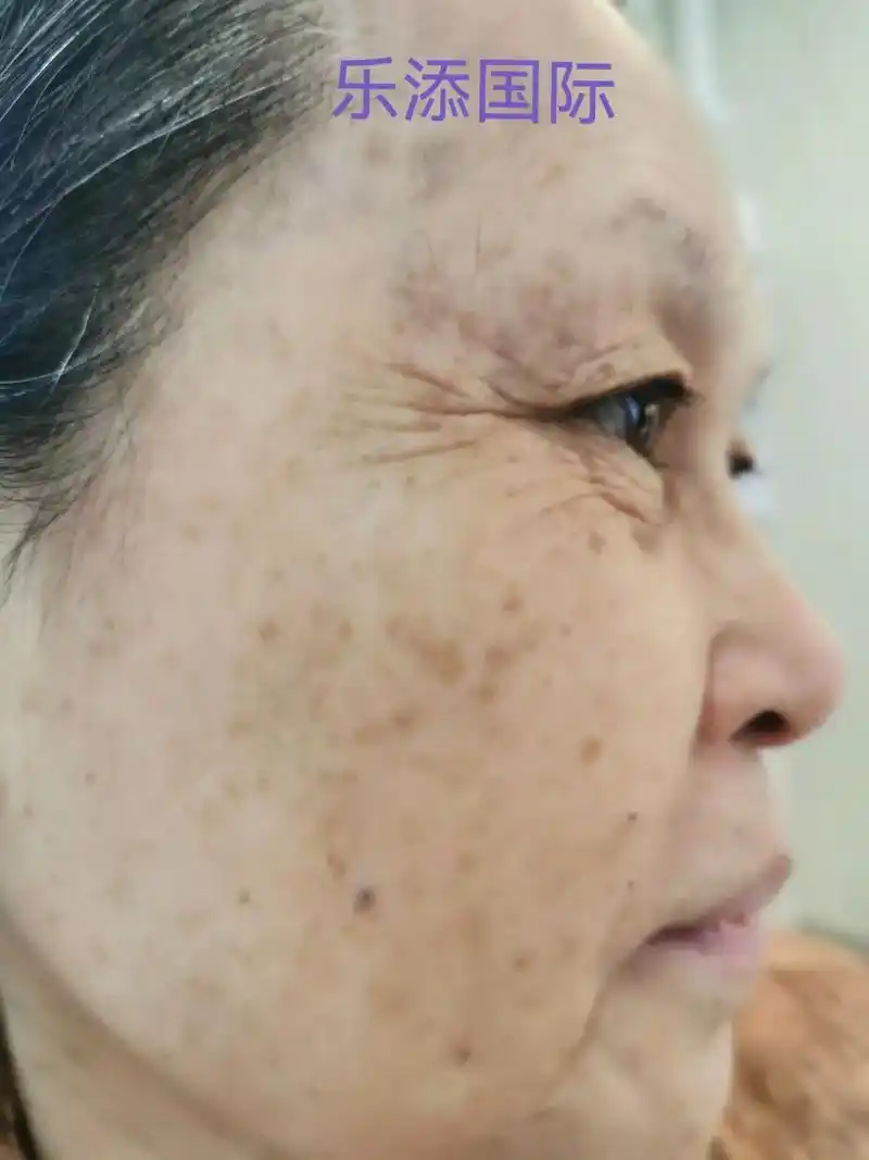 海口某医院主任医师罗女士严重混合问题性皮肤(衰老性皱纹,,黑 - 抖音