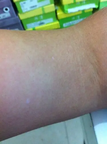 皮肤上面出现这些白点是什么情况