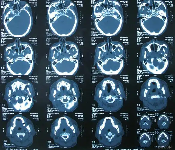 【病例讨论】上颌骨骨折何以引起张口受限 [病例帖]