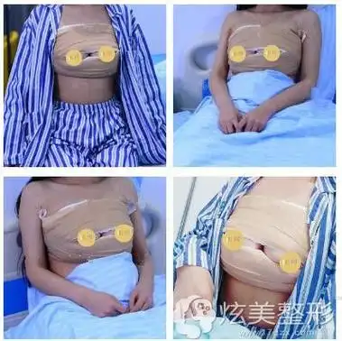 郭震宇主刀在广州联合丽格做曼托假体隆胸自然聚拢恢复快